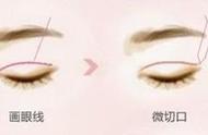 做完韩式定点双眼皮需要注意什么（术前术后注意事项有哪些）