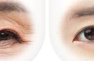眼部除皱什么方法最持久（激光眼部除皱的注意事项和优势有哪些）