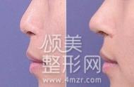 南京注射玻尿酸隆鼻的价格是多少（注射隆鼻的价格和假体隆鼻整形有什么区别）