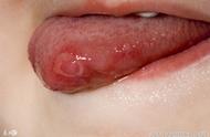 舌癌早期的6个症状（舌癌早期有哪些症状）