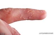 手指脱皮是缺什么维生素（预示身体缺乏这种维生素）