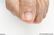 指甲表面有竖纹是怎么回事（对照6个原因）