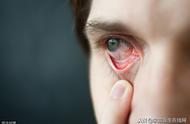 眼球有红血丝的原因是什么（或是疾病发射出来的信号）