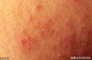 急性湿疹严重的表现（夏天9种常见皮肤病的病因、症状汇总及治疗方案）
