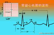 心电图怎么看早博的频率（如何治疗早搏）
