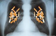 肺癌最明显的一个征兆图片（可能是肺在“喊救命”）