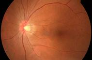 如何区分单纯近视和病理近视（聊聊高度近视和病理性近视）