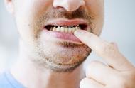 牙龈炎和牙周炎有什么关系（你分清了吗）
