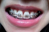 牙和牙龈交界处有个洞（牙齿矫正的副作用）