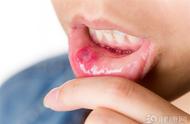 口腔癌的7个前兆（7个症状出现过吗）