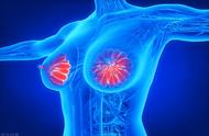 乳腺癌的5大早期症状女性必知（提示乳腺癌早期）