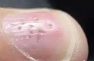 指甲疾病的图片和说明（是身体出问题了）
