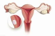 女性得了宫颈癌是什么原因造成的（宫颈癌的致病因素有哪些）