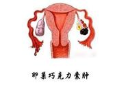 卵巢巧克力囊肿治疗方法（|）