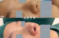 假体隆鼻过程真人视频（北京隆鼻案例分享）