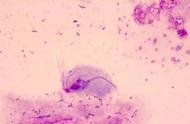 滴虫阴道炎与霉菌性阴道炎鉴别（教你怎么辨别滴虫性、霉菌性、细菌性、萎缩性阴道炎）
