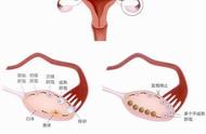 多卵巢综合征怎么导致的（治疗方式主要有两种）